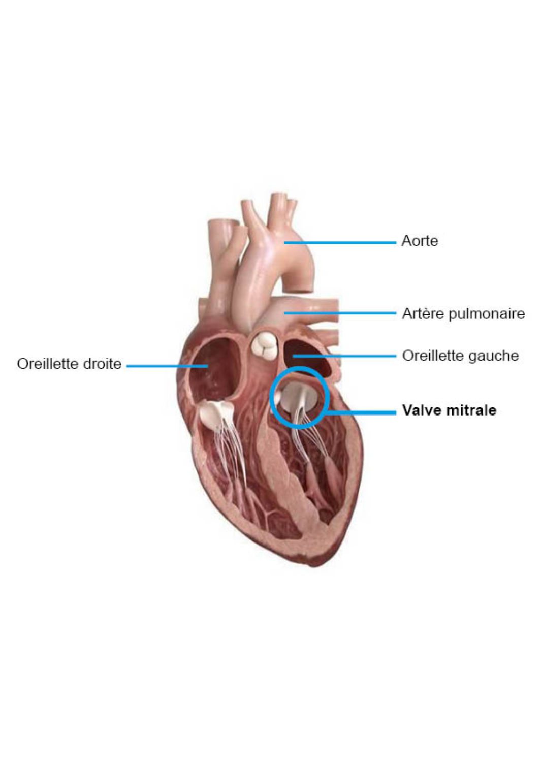 Coeur renovalve