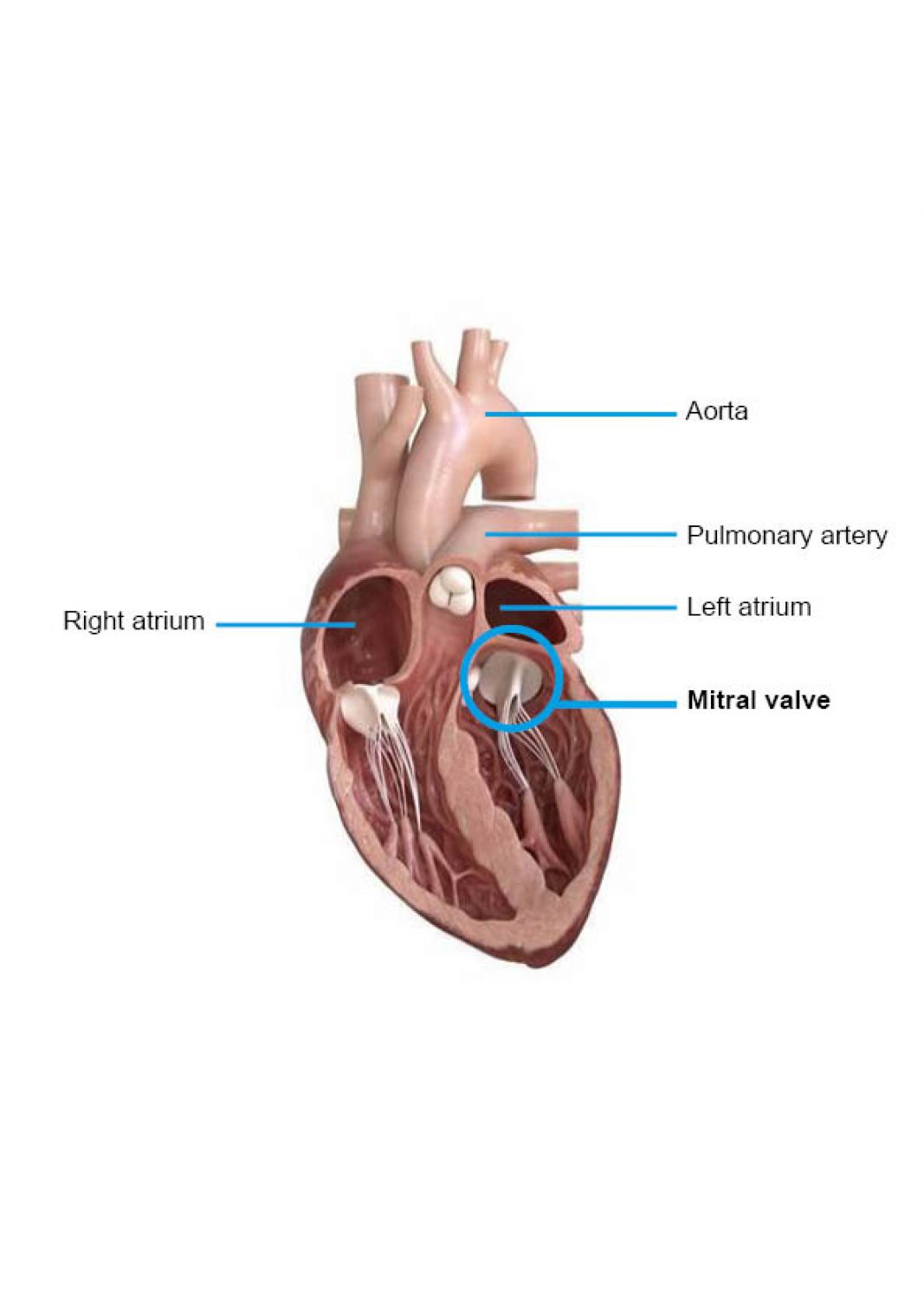 Renovalve coeur